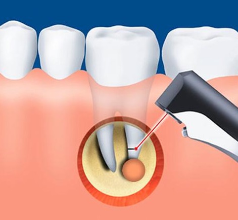 Лечение кист и гранулем в стоматологической клинике Ладент
