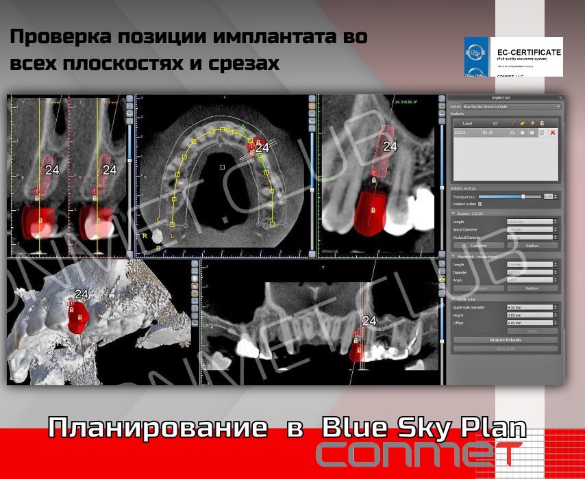 Планирование в Blue Sky Plan - соблюдение зоны безопастности до анатомических структур и других имплантатов.